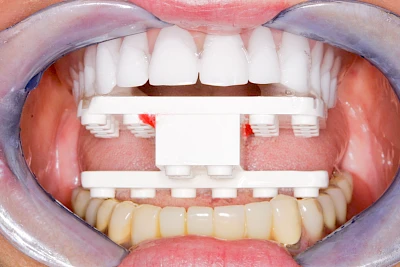 Beispiele: Implantatplanung
