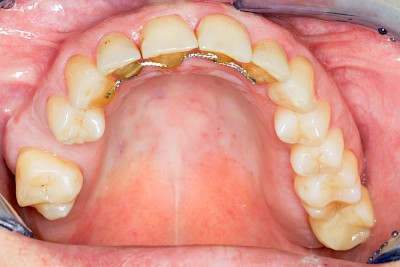 Beispiele: Implantate und festsitzende Kronen & Brücken