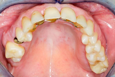 Nach Freilegung Implantat & Gingivaformer (Übersicht)
