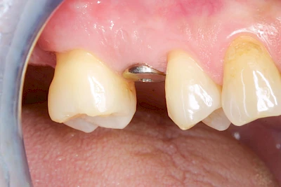 Nach Freilegung Implantat & Gingivaformer (Nahaufnahme)