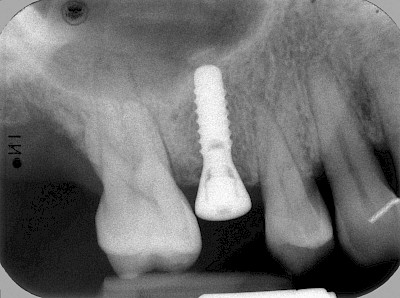 Beispiele: Implantate und festsitzende Kronen & Brücken