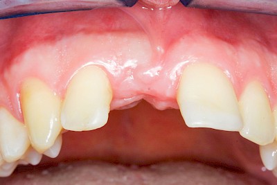 Beispiele: Implantate und festsitzende Kronen & Brücken