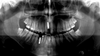 Beispiele: Implantate und festsitzende Kronen & Brücken