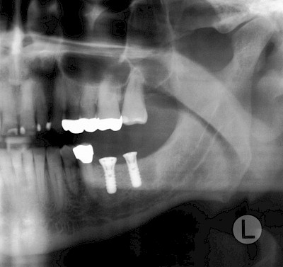 Beispiele: Implantate und festsitzende Kronen & Brücken