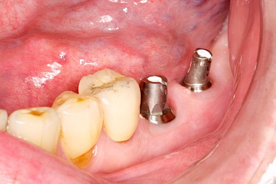 Beispiele: Implantate und festsitzende Kronen & Brücken