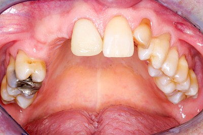 Beispiele: Implantate und festsitzende Kronen & Brücken