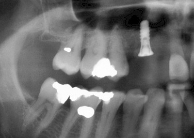 Beispiele: Implantate und festsitzende Kronen & Brücken