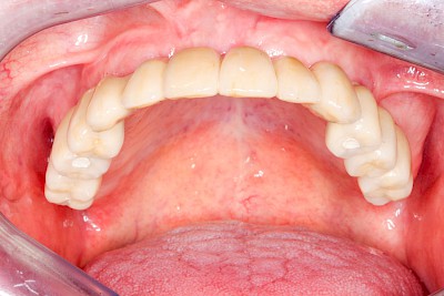 Beispiele: Implantate und festsitzende Kronen & Brücken