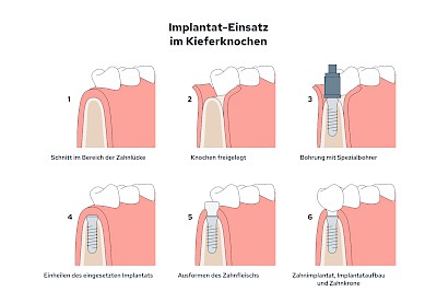 Beispiele: Implantate und festsitzende Kronen & Brücken