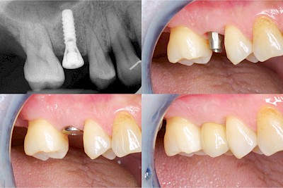 Beispiele: Implantate und festsitzende Kronen & Brücken