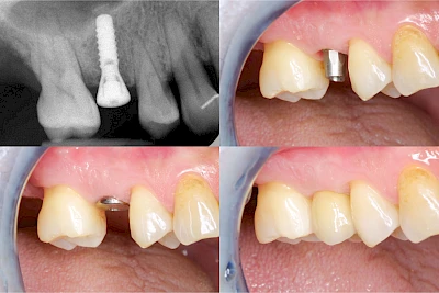 Implantation: Phasen der Versorgung