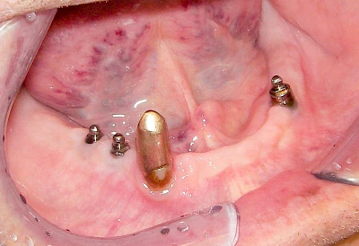 Beispiele: Implantate und herausnehmbare Prothesen