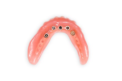 Beispiele: Implantate und herausnehmbare Prothesen