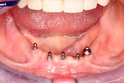 Beispiele: Implantate und herausnehmbare Prothesen