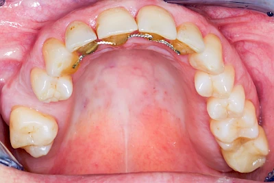 Beispiele: Zahnspange, Multiband, Retainer & Aligner