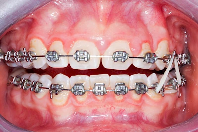 Beispiele: Zahnspange, Multiband, Retainer & Aligner