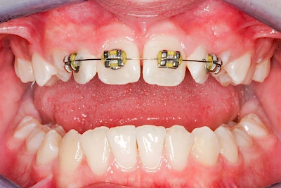 Beispiele: Zahnspange, Multiband, Retainer & Aligner