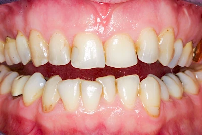 Beispiele: Zahnspange, Multiband, Retainer & Aligner