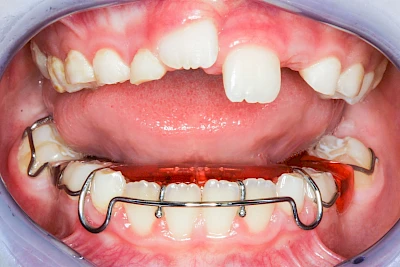 Beispiele: Zahnspange, Multiband, Retainer & Aligner