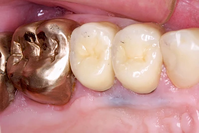 Beispiele: Metalltätowierung