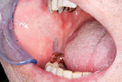 Beispiele: Metalltätowierung