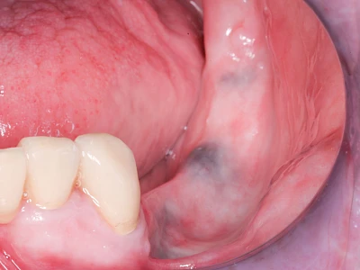 Beispiele: Metalltätowierung