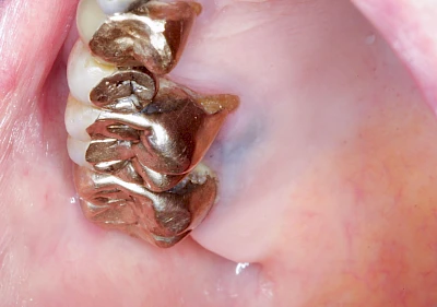 Beispiele: Metalltätowierung