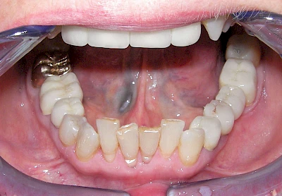 Beispiele: Metalltätowierung