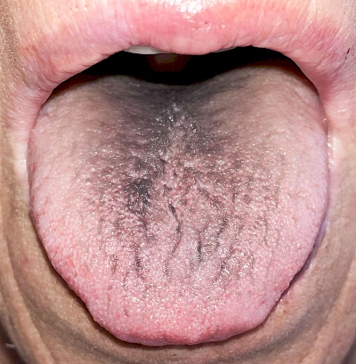 Beispiele: Chlorhexidin-Verfärbung