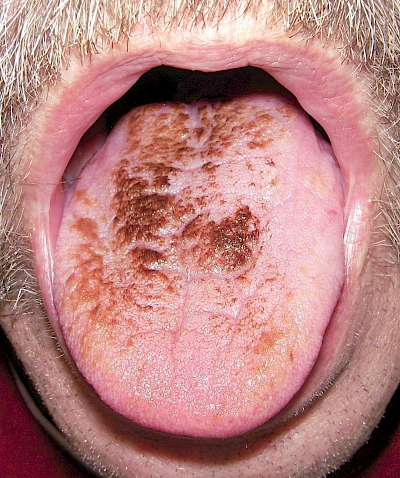 Beispiele: Chlorhexidin-Verfärbung