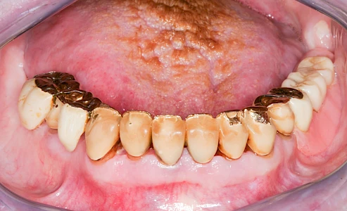 Zahnprothese