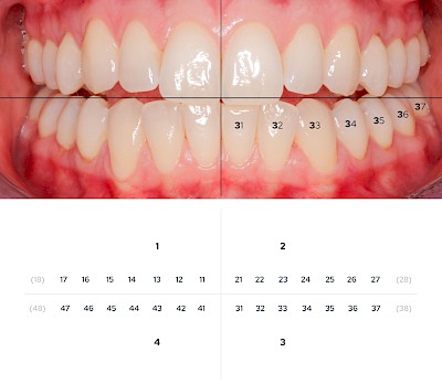 Zahnschema Bleibendes Gebiss