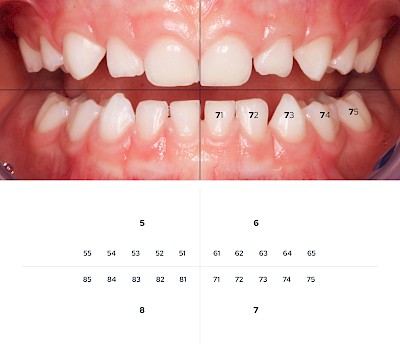 Zahnschema Milchgebiss