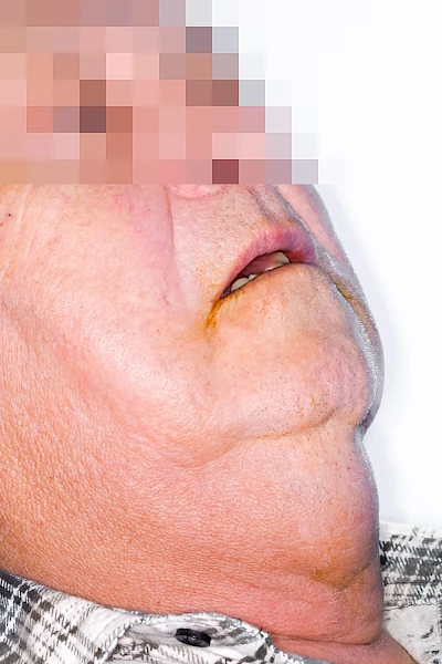Beispiele: Schwellung durch Lymphstau