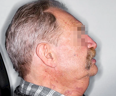 Beispiele: Schwellung durch Lymphstau