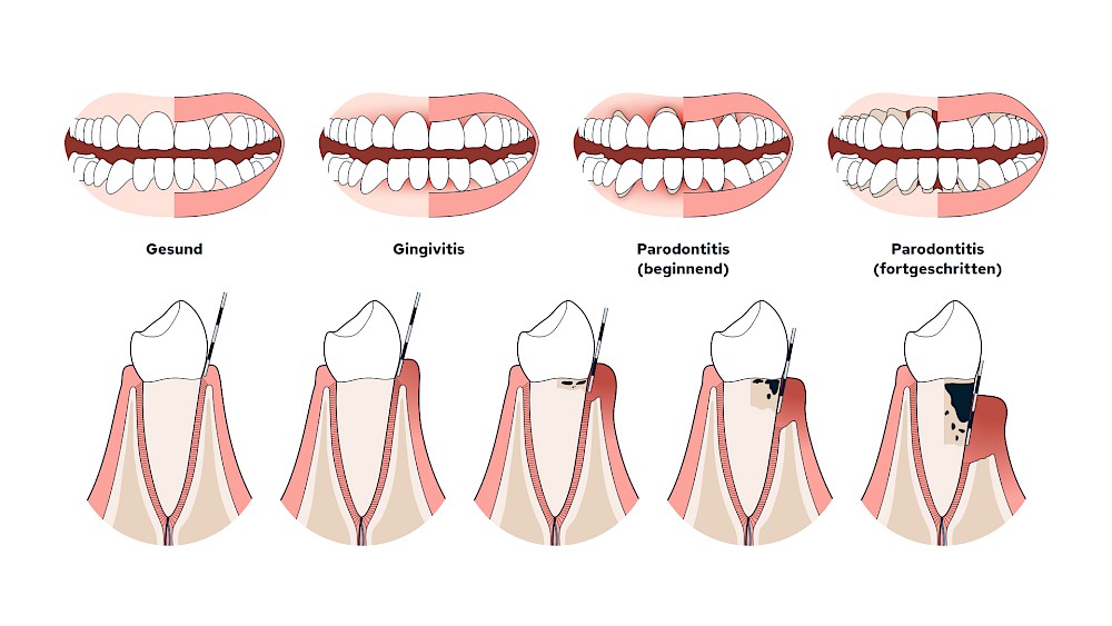 Stadien der Parodontitis