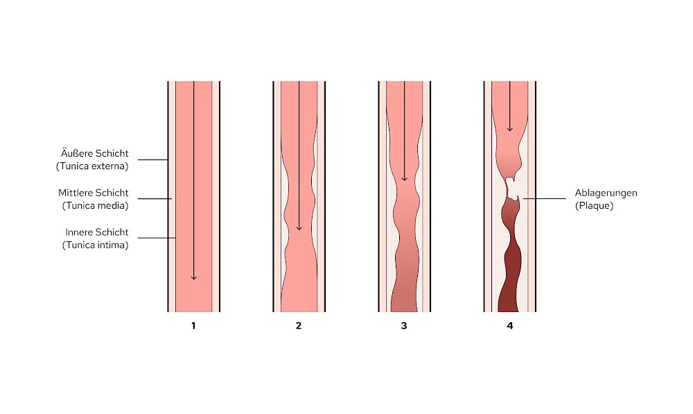 Aufbau großer Blutgefäße & Entstehung von Ablagerungen