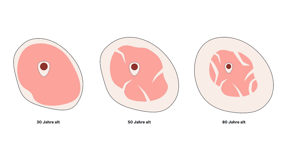 Sarkopenie: Muskelgewebe wird im Alterungsprozess durch Fett ersetzt