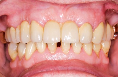 Beispiele Gesundes Zahnfleisch