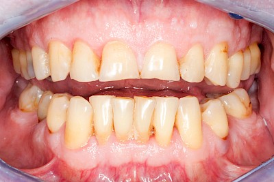 Beispiele Gesundes Zahnfleisch