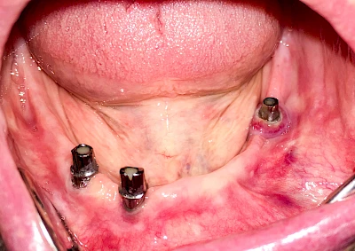 Heute: Periimplantitis (Implantat links hinten)
