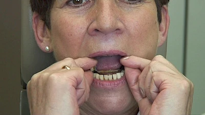 Beispiele: Aus- & Eingliederung von Zahnprothesen