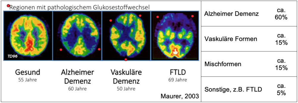 Primäre Demenzen: Beispiele