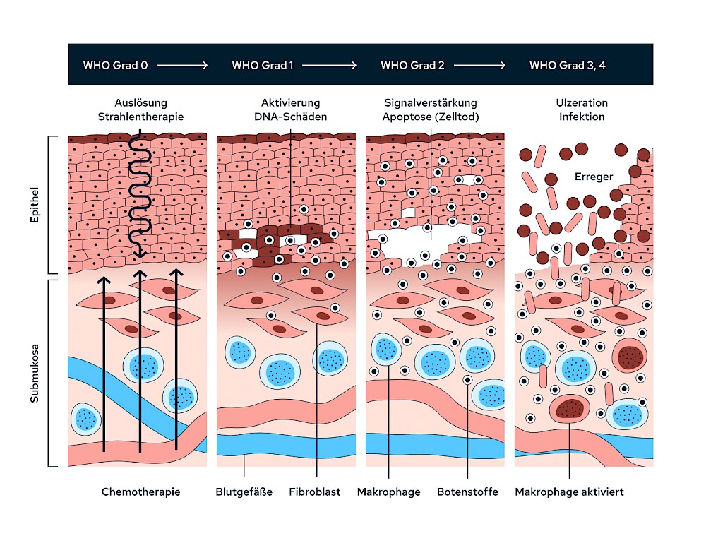 Bestrahlung: Dermatitis, Mukositis & Pilz