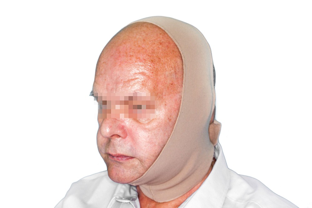 Kopf-Kinn-Bandage bei Lymphstau