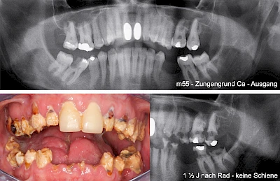 Beispiele: Radiogene Läsionen, Strahlenkaries