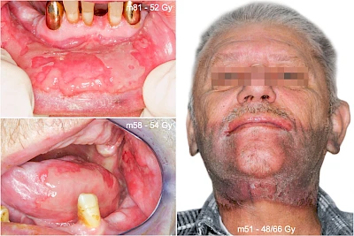 Beispiele: Dermatitis, Mukositis & Pilz
