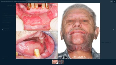 Presse Bestrahlung: Dermatitis, Mukositis & Pilz