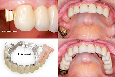 Teilprothese: Geschiebeprothese