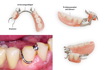 Teilprothese: Klammerprothese